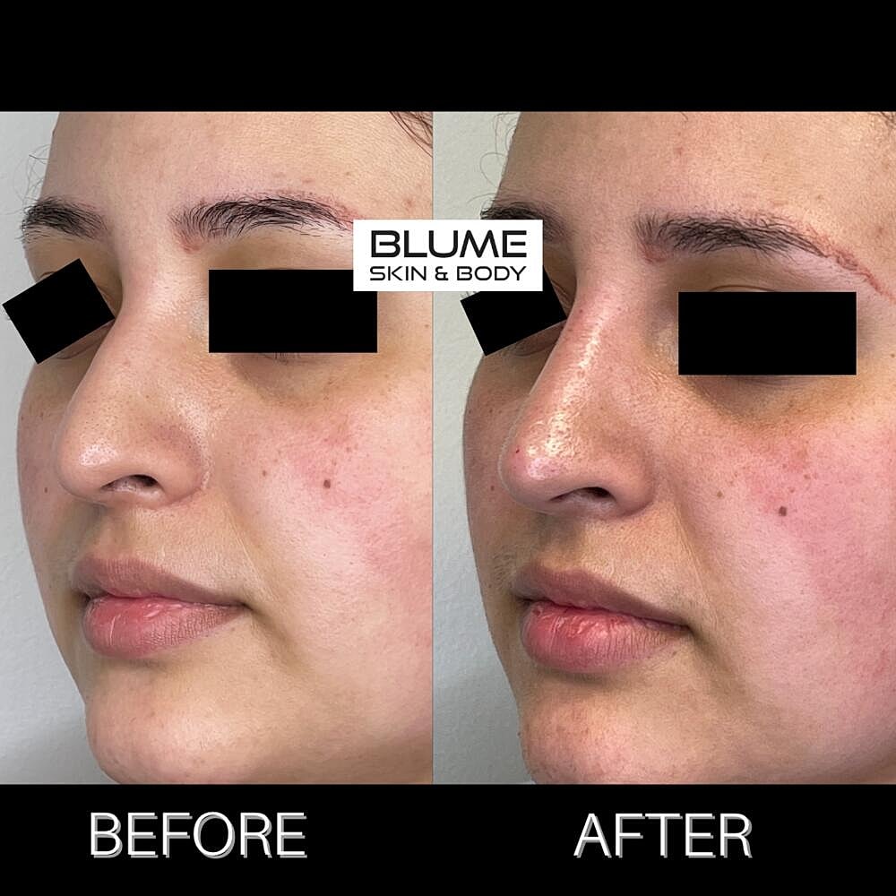 Dermal Fillers Before & After