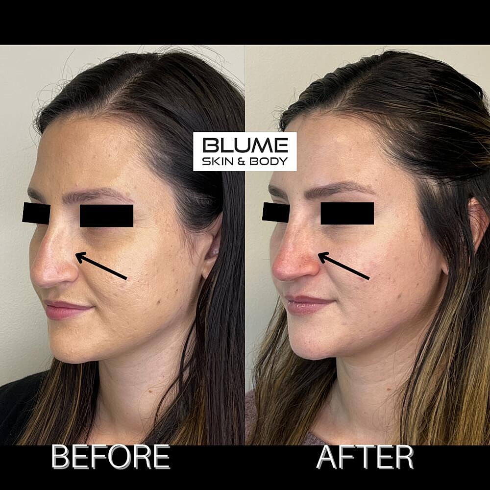 Dermal Fillers Before & After