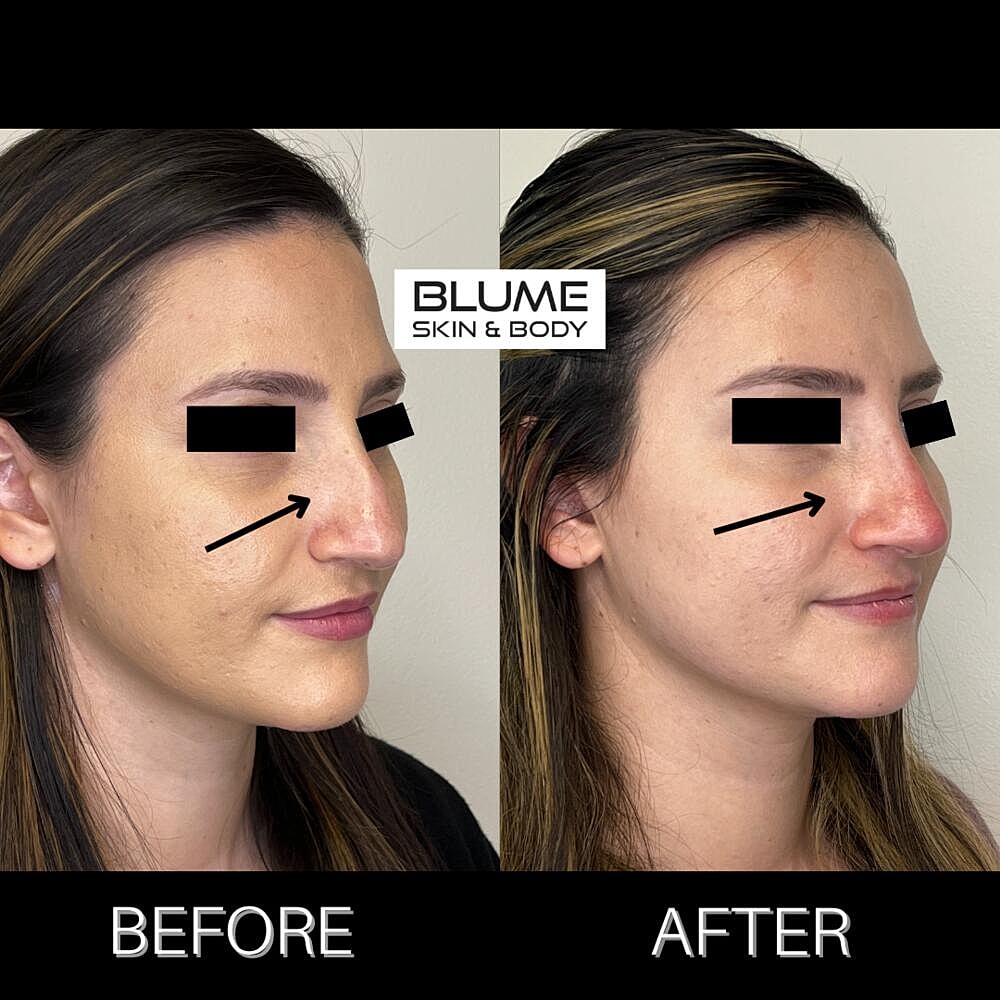 Dermal Fillers Before & After
