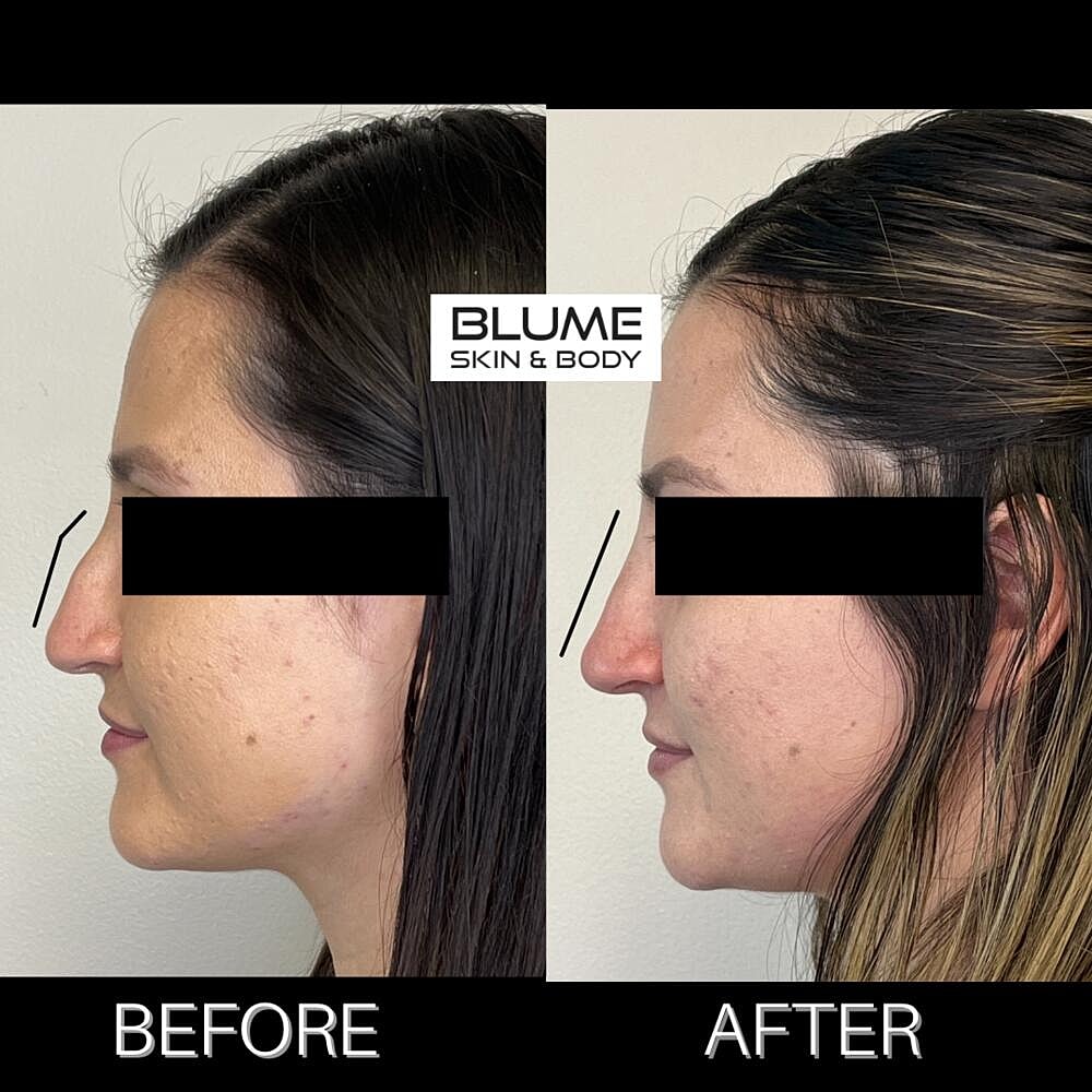 Dermal Fillers Before & After