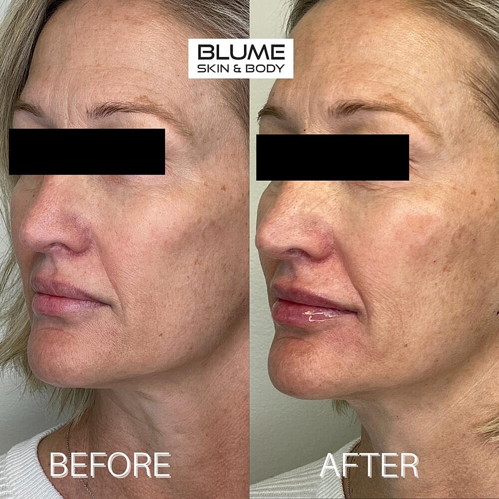 Dermal Fillers Before & After