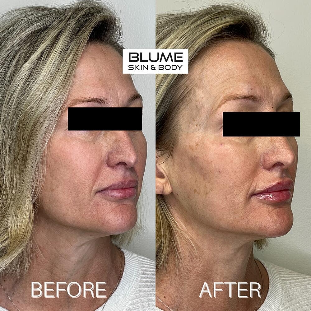 Dermal Fillers Before & After