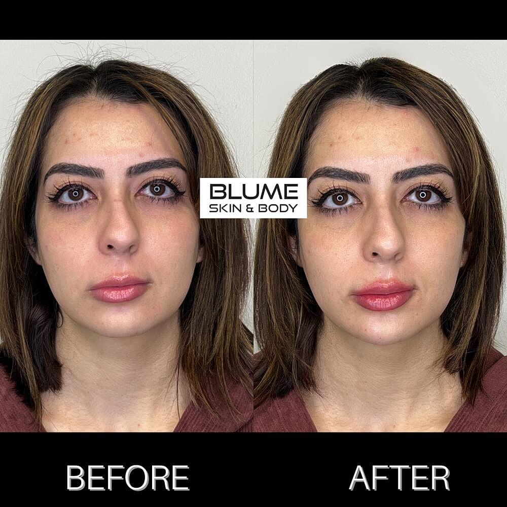 Dermal Fillers Before & After