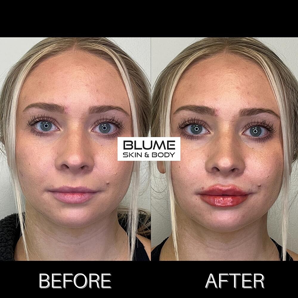 Dermal Fillers Before & After