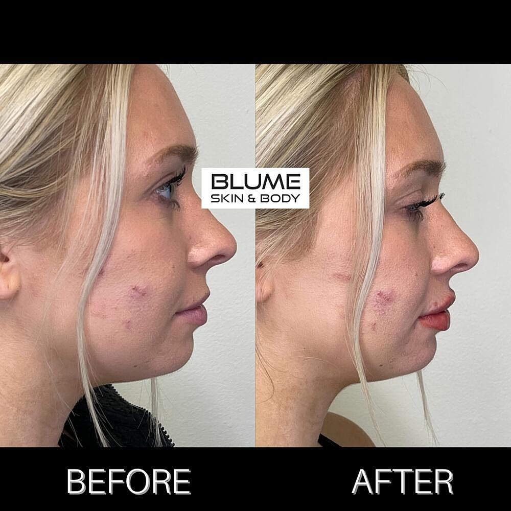Dermal Fillers Before & After