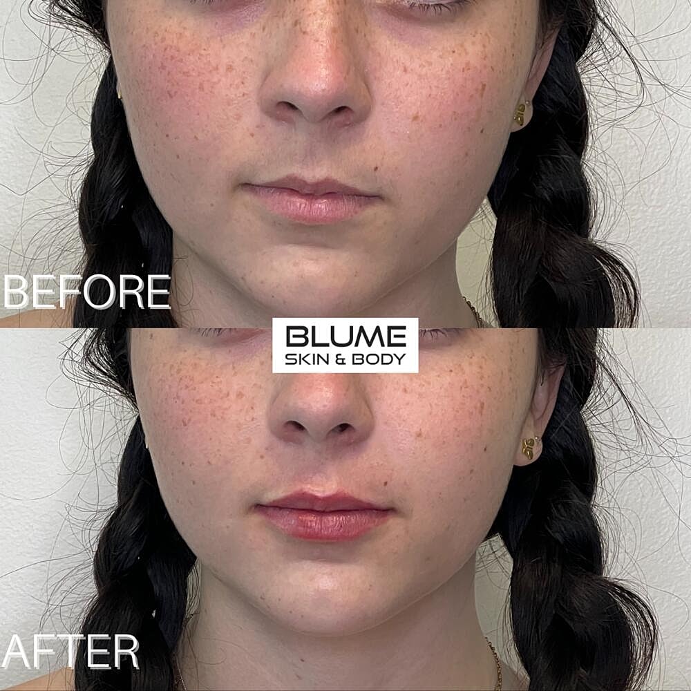 Dermal Fillers Before & After