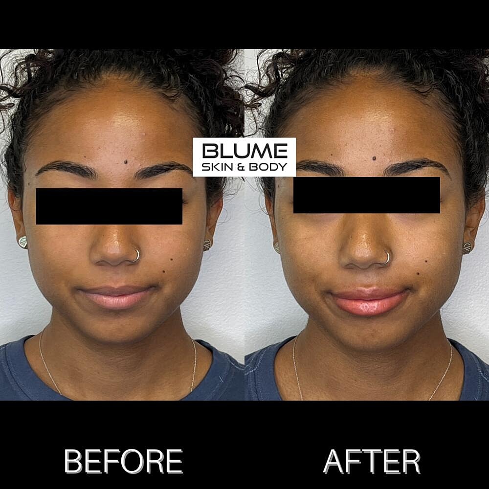 Dermal Fillers Before & After