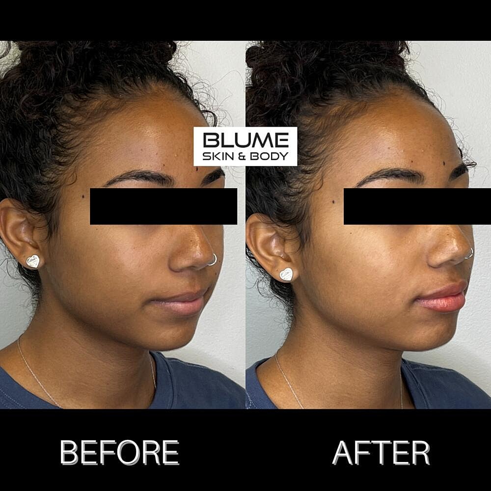 Dermal Fillers Before & After