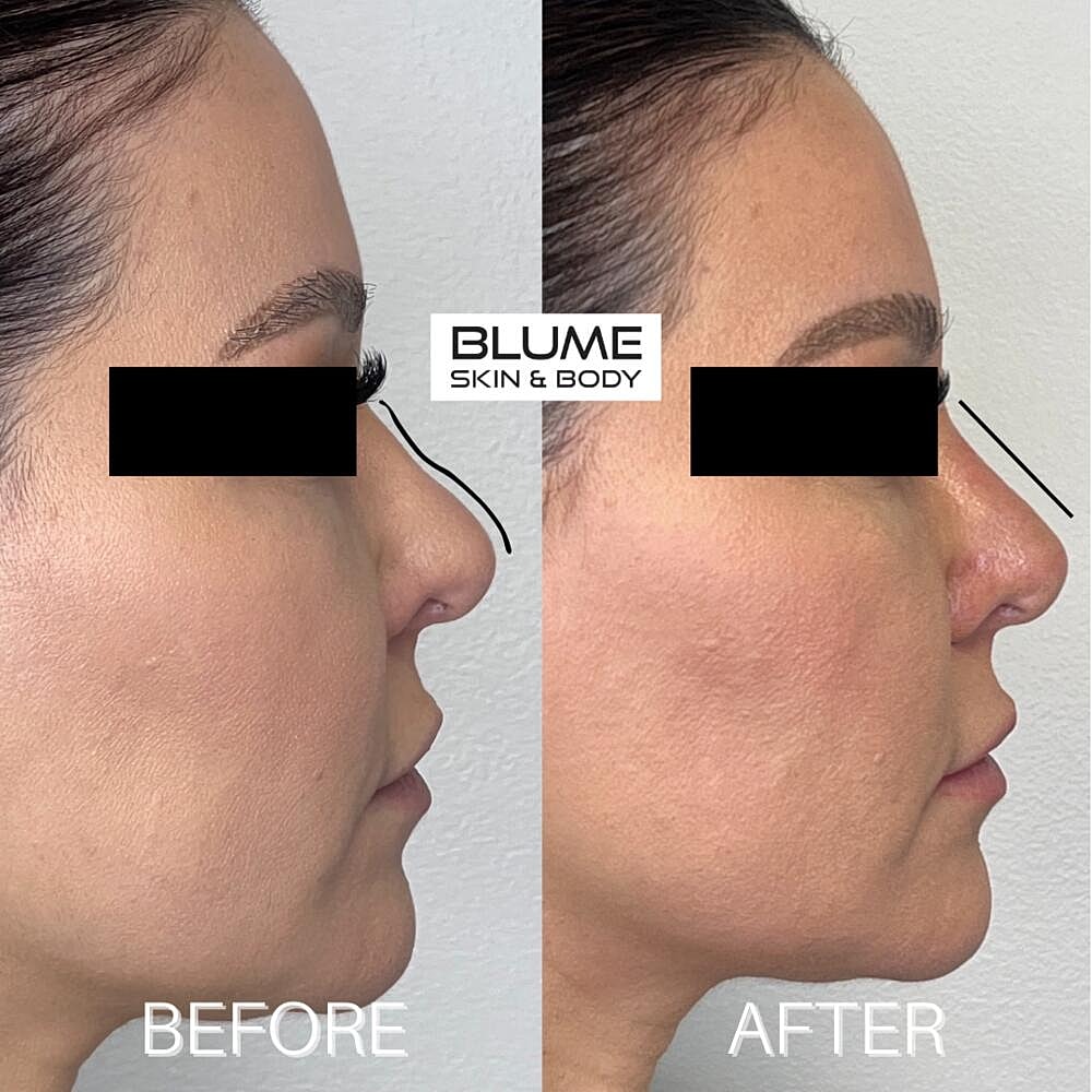 Dermal Fillers Before & After
