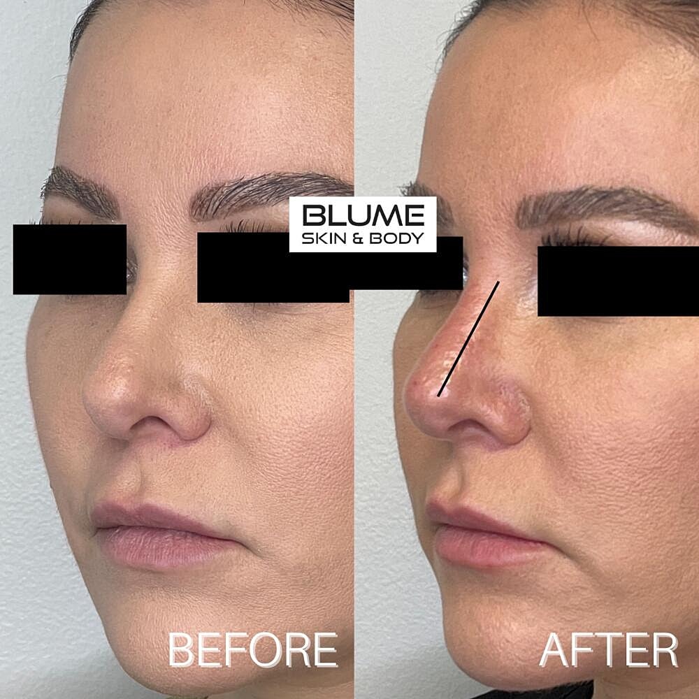 Dermal Fillers Before & After