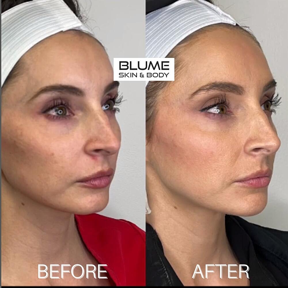 Dermal Fillers Before & After