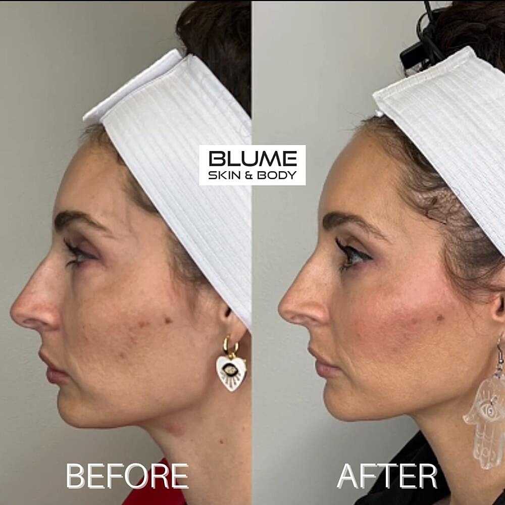 Dermal Fillers Before & After