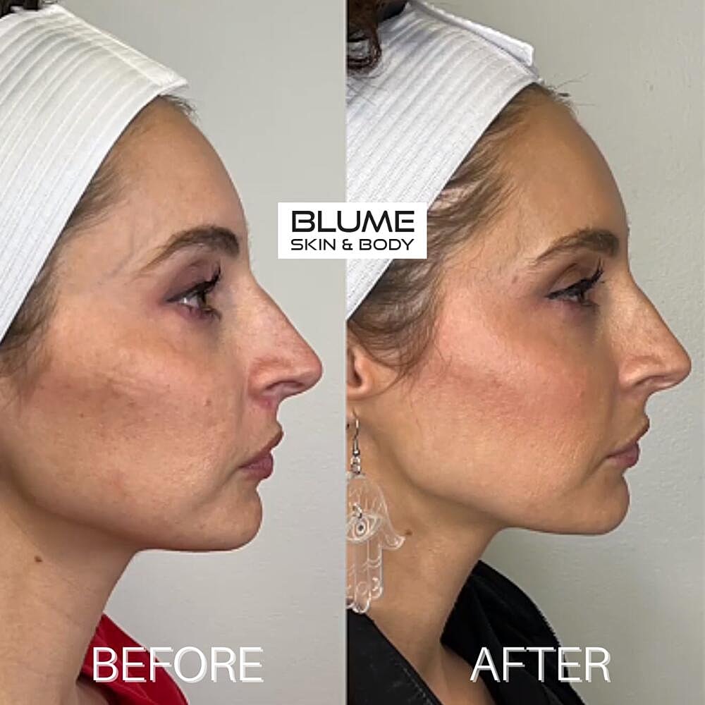 Dermal Fillers Before & After