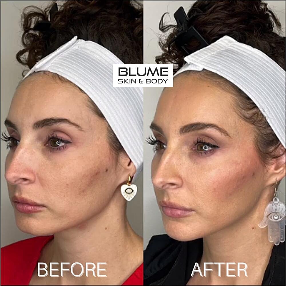 Dermal Fillers Before & After