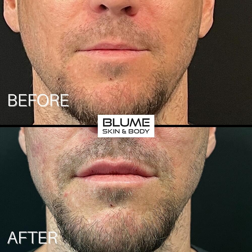 Dermal Fillers Before & After