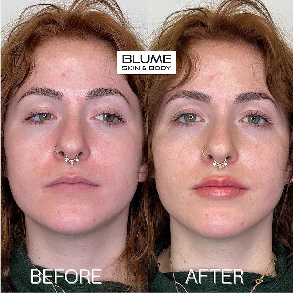 Dermal Fillers Before & After