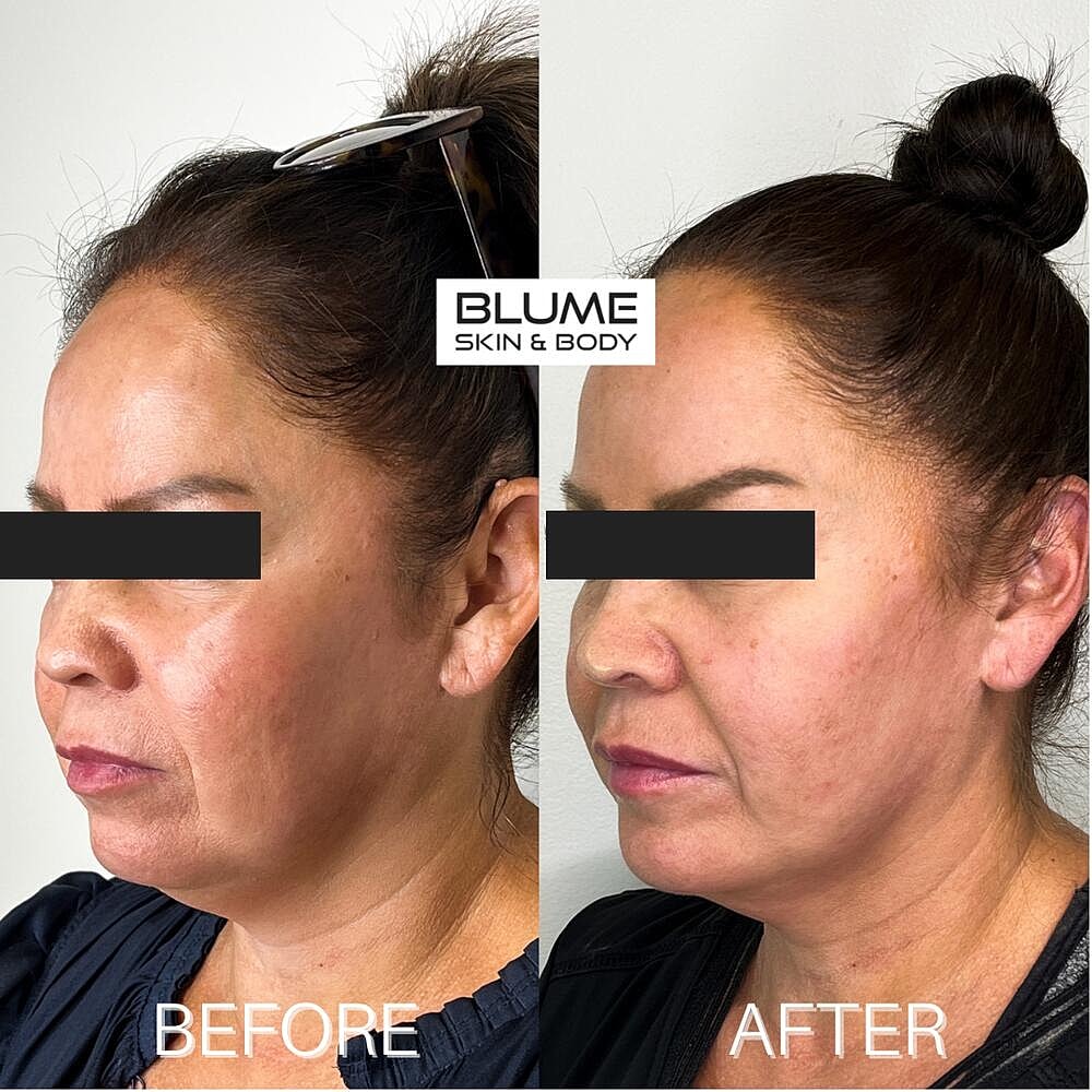 Dermal Fillers Before & After