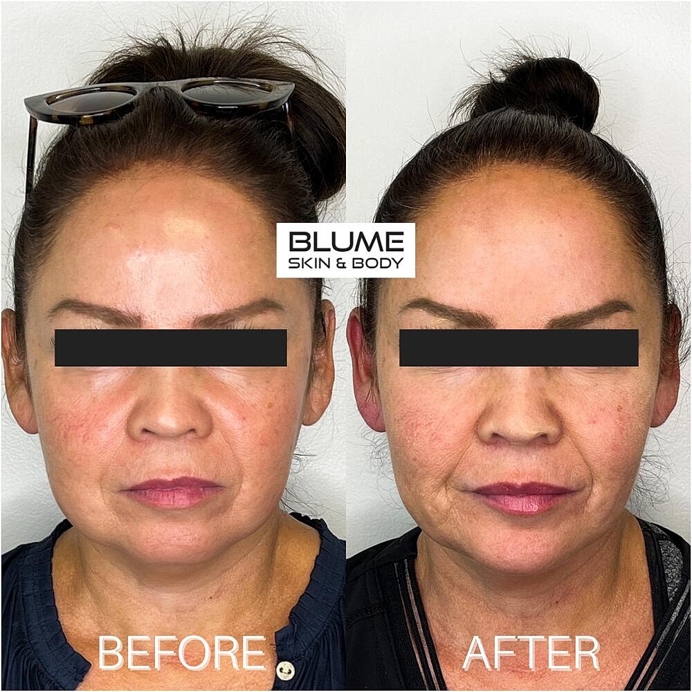Dermal Fillers Before & After