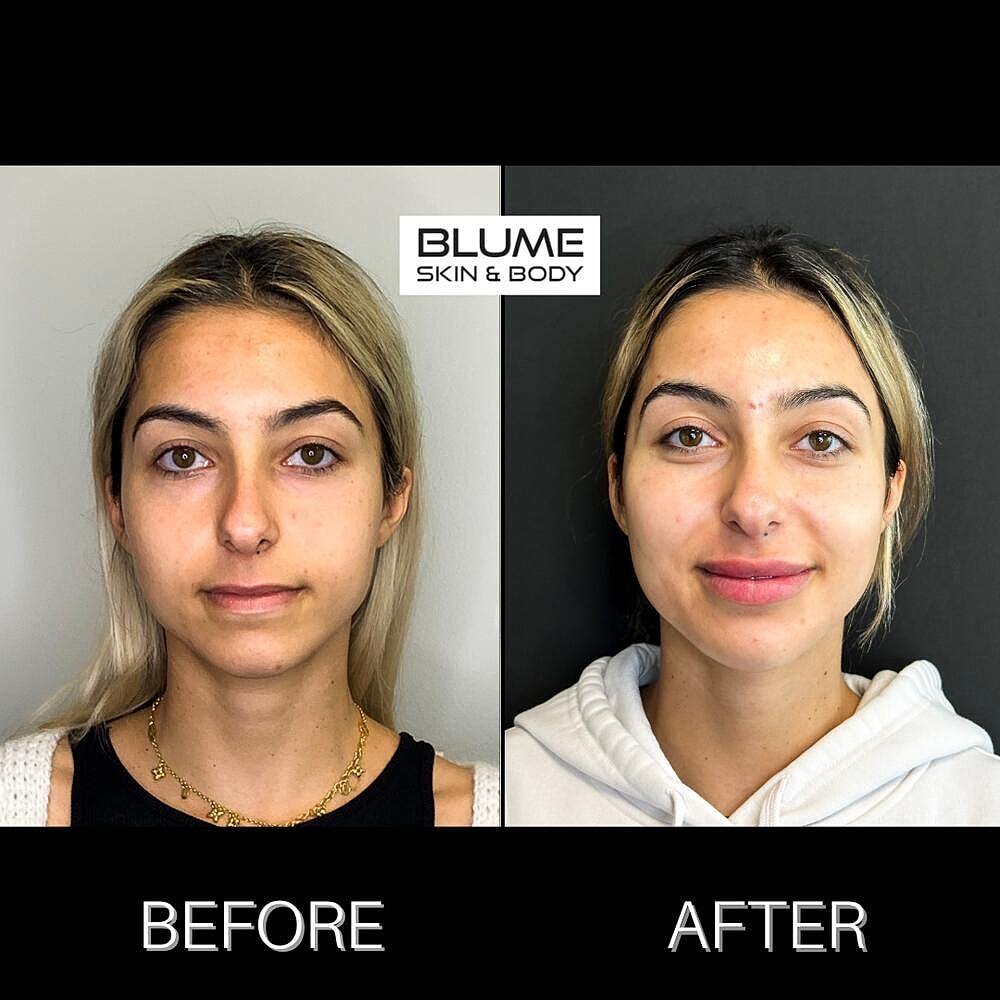 Dermal Fillers Before & After
