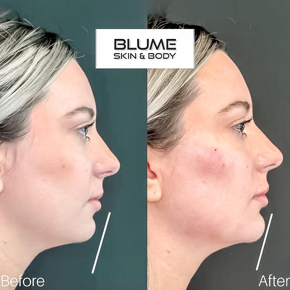 Dermal Fillers Before & After