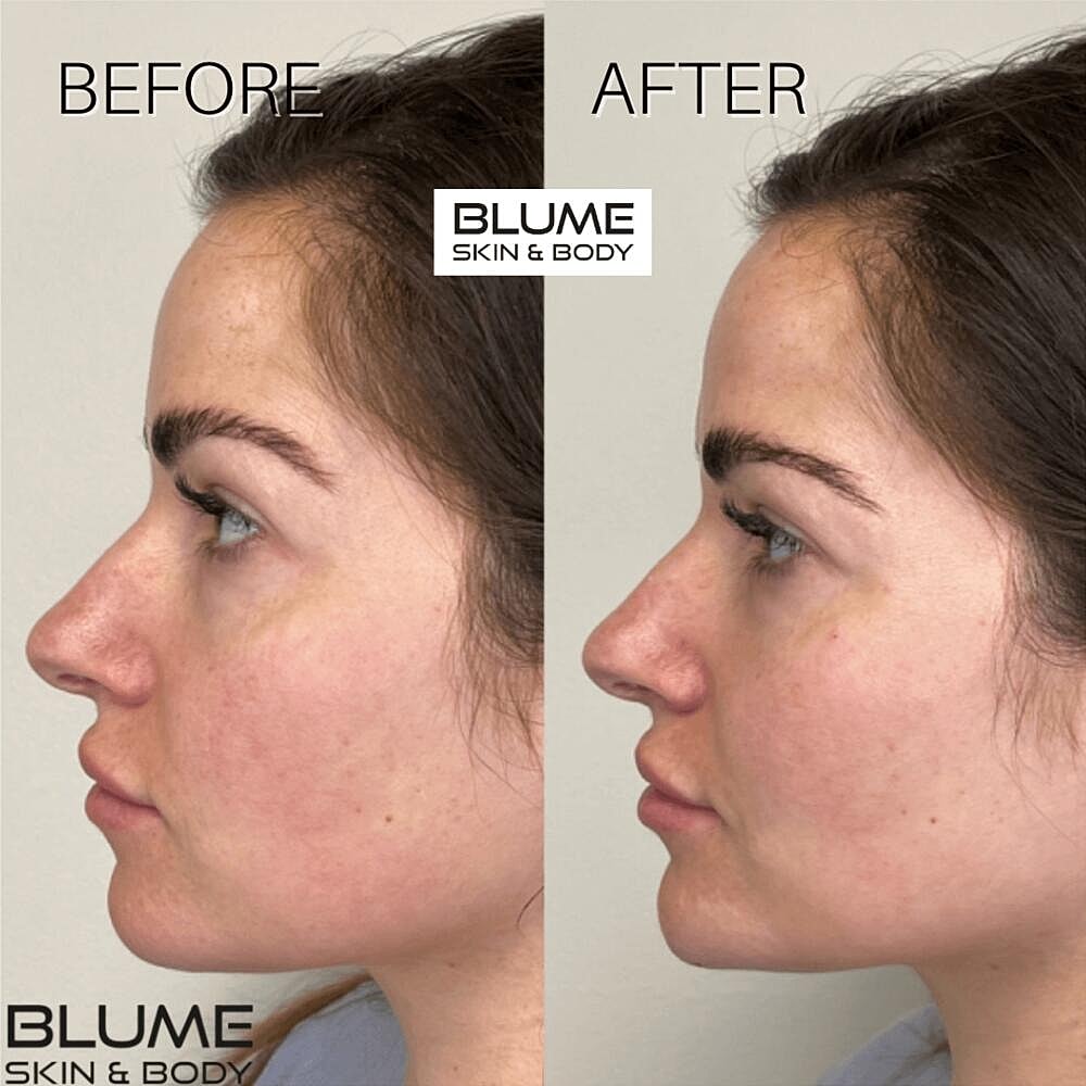 Dermal Fillers Before & After