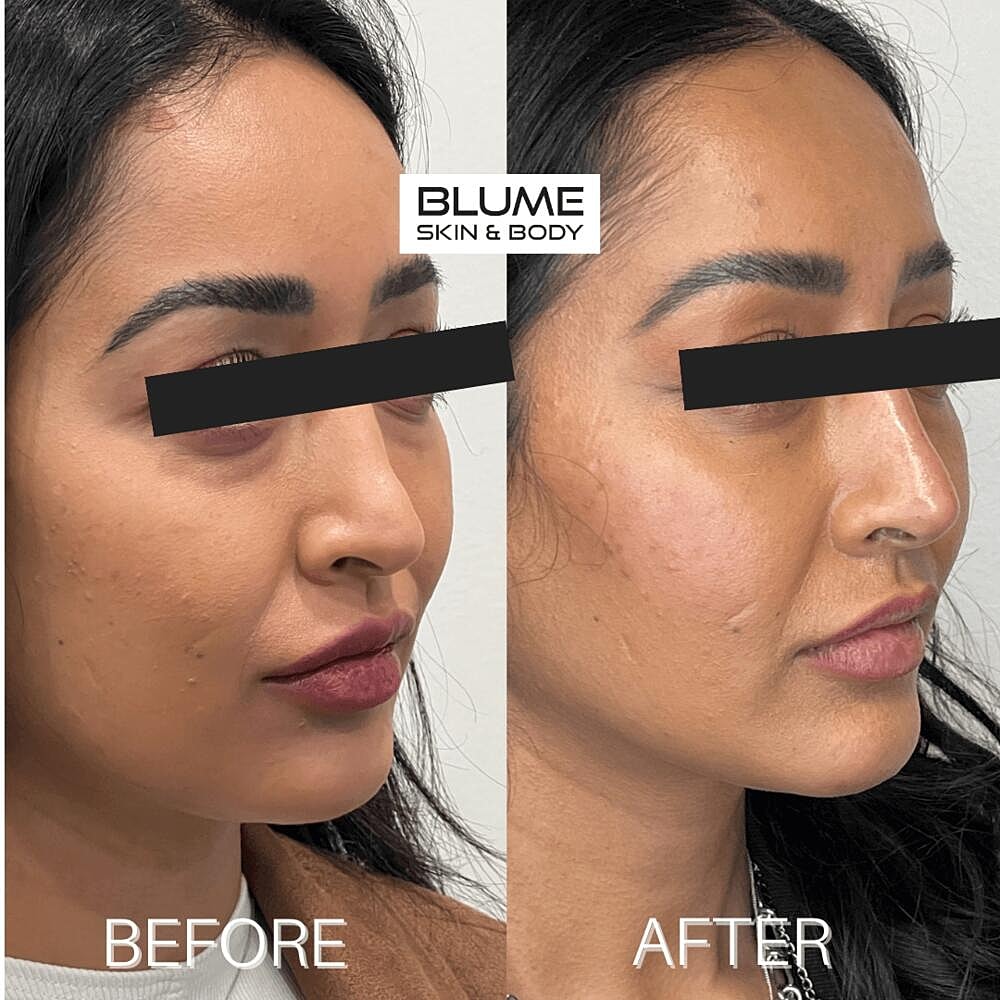 Dermal Fillers Before & After