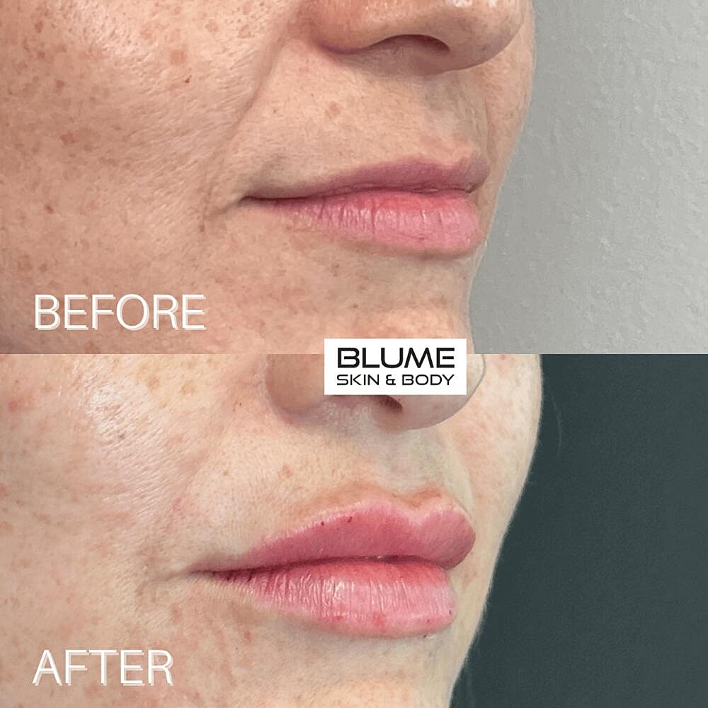 Dermal Fillers Before & After