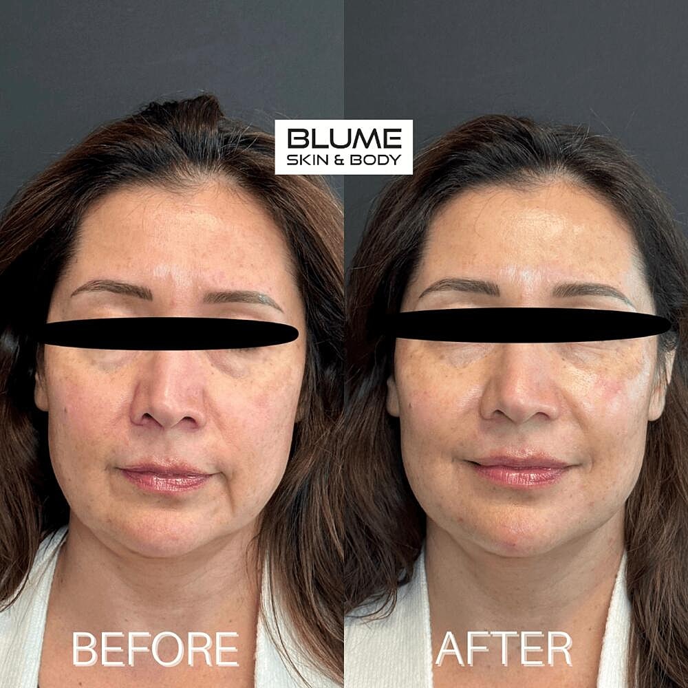 Dermal Fillers Before & After