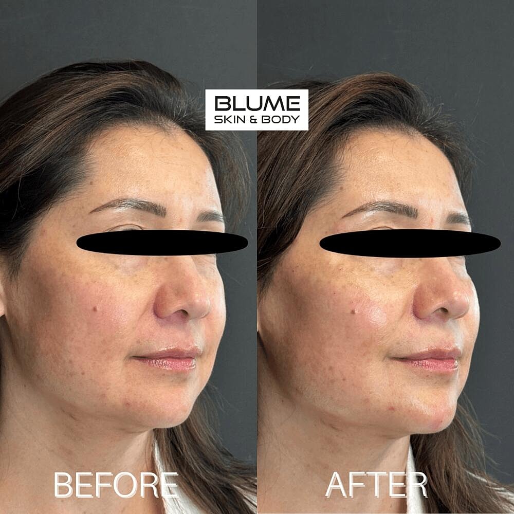 Dermal Fillers Before & After