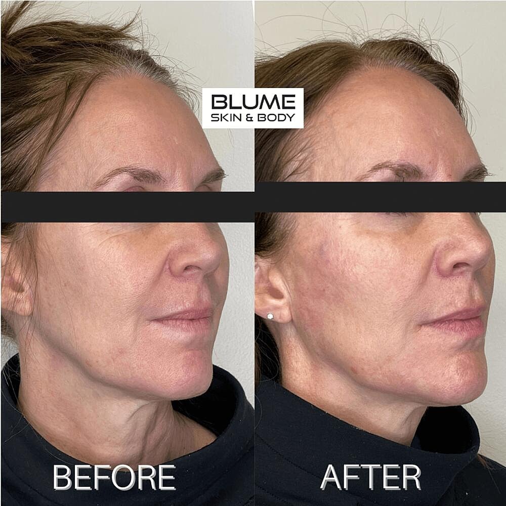 Dermal Fillers Before & After