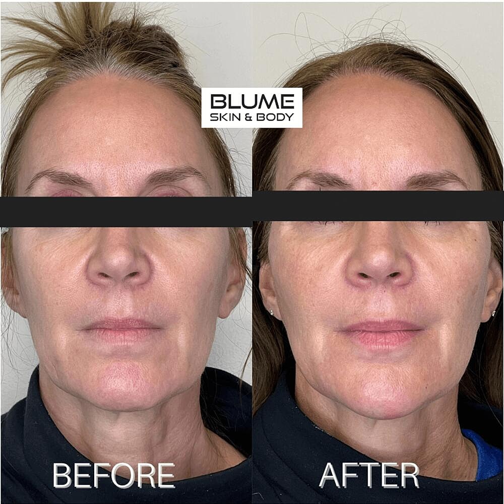 Dermal Fillers Before & After