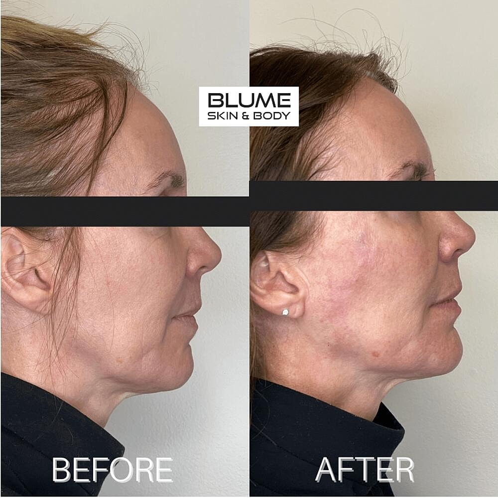 Dermal Fillers Before & After