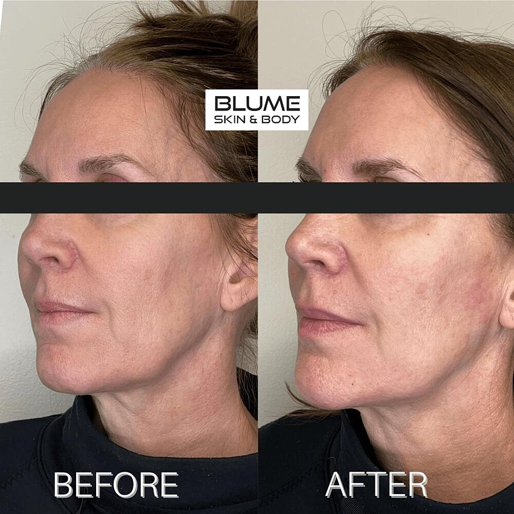 Dermal Fillers Before & After