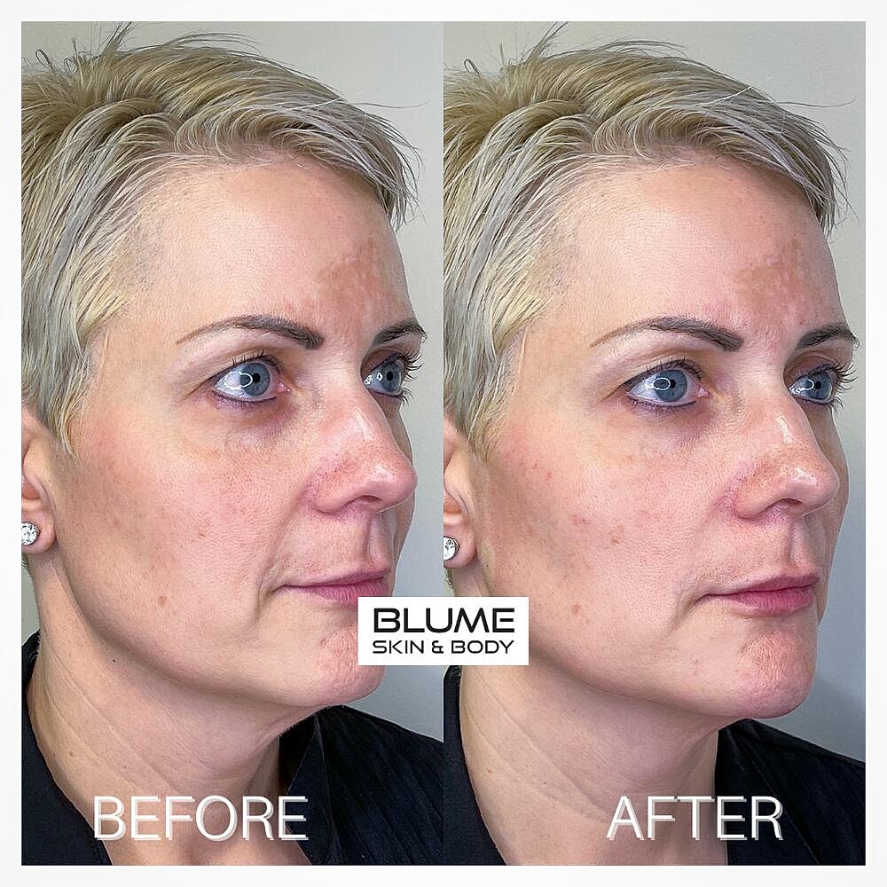 Dermal Fillers Before & After