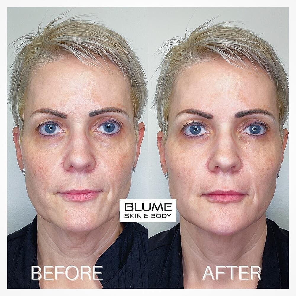 Dermal Fillers Before & After