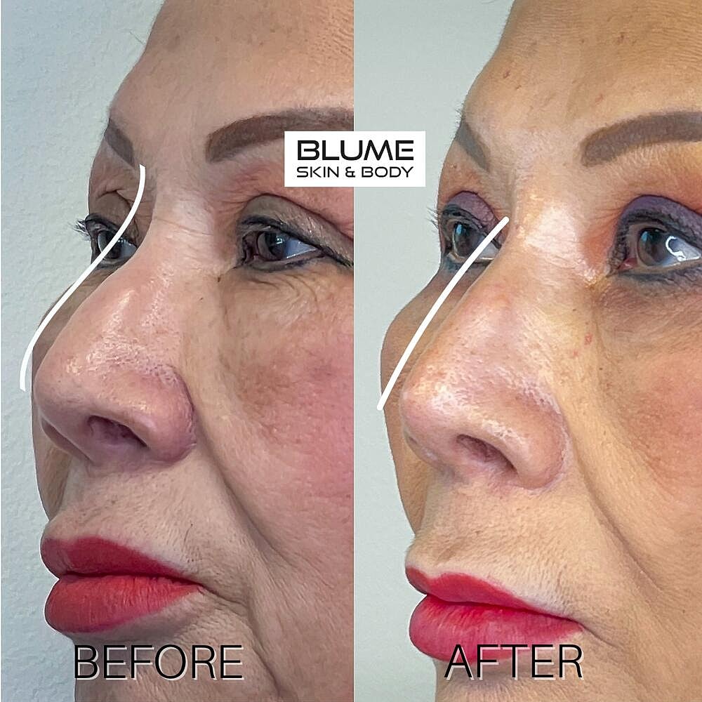 Dermal Fillers Before & After