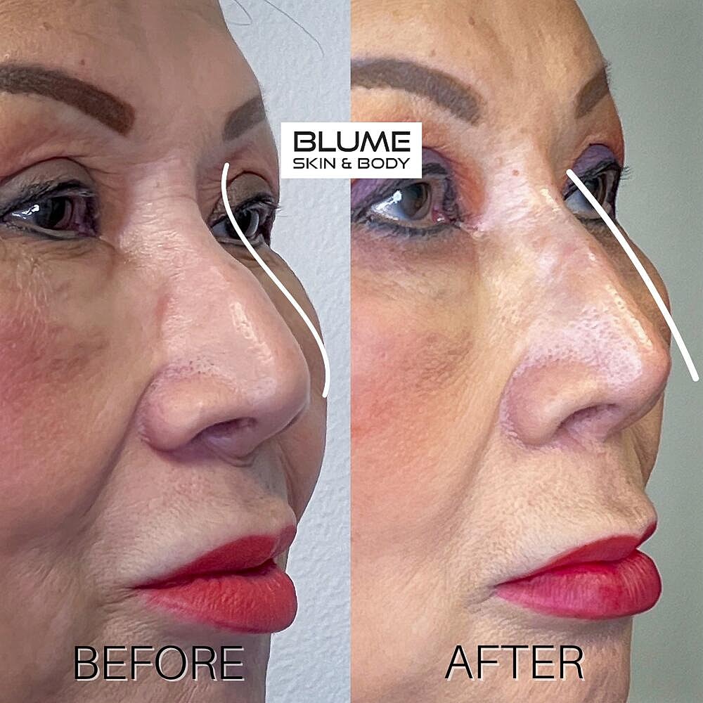 Dermal Fillers Before & After