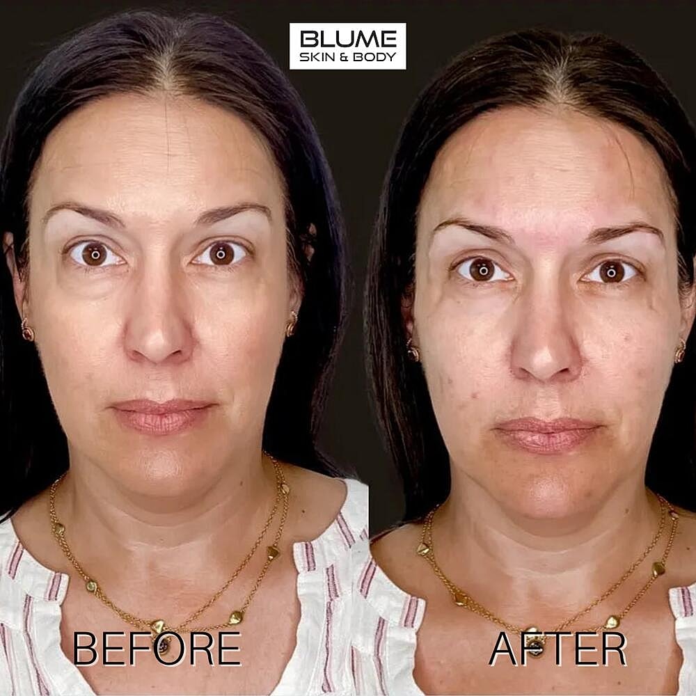 Dermal Fillers Before & After