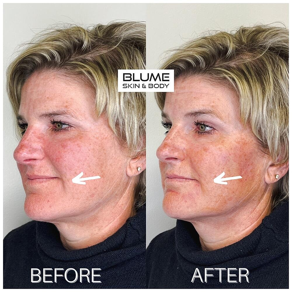 Dermal Fillers Before & After