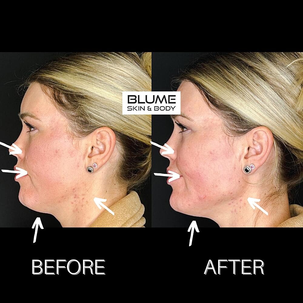 Dermal Fillers Before & After