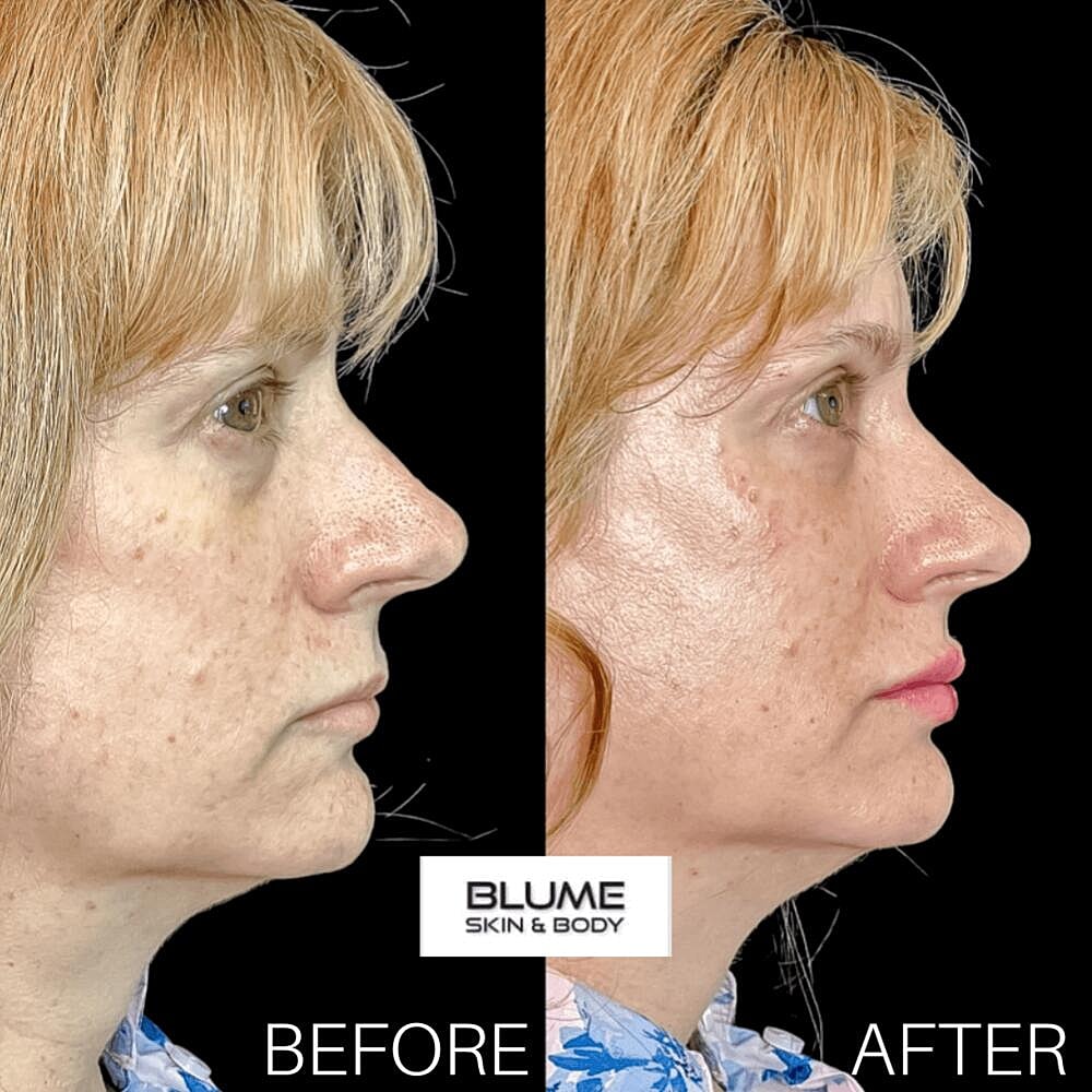 Dermal Fillers Before & After