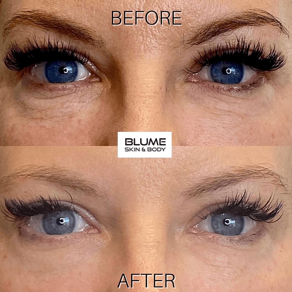 Dermal Fillers Before & After