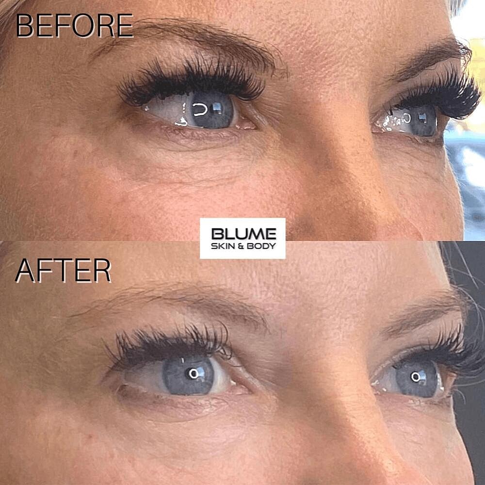 Dermal Fillers Before & After