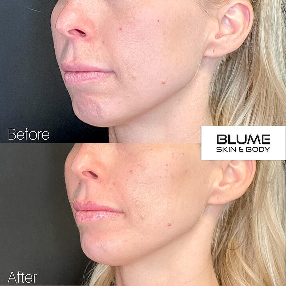 Dermal Fillers Before & After