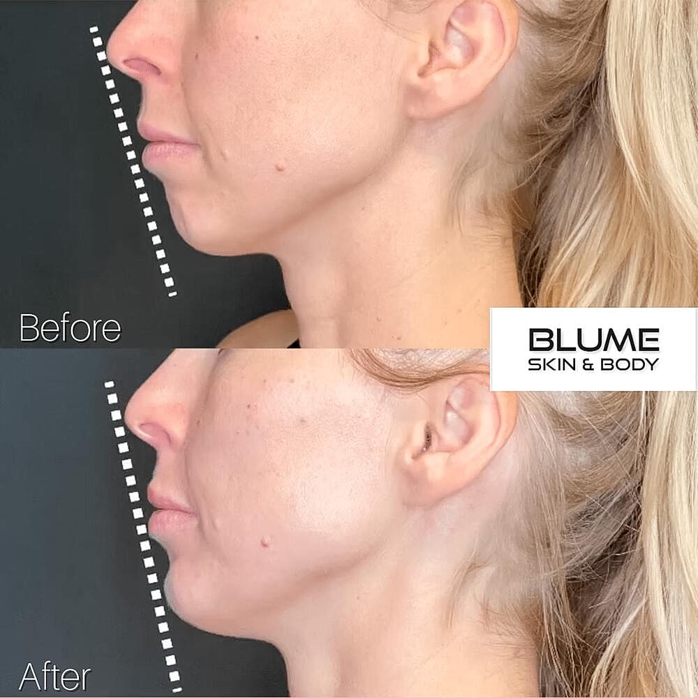 Dermal Fillers Before & After