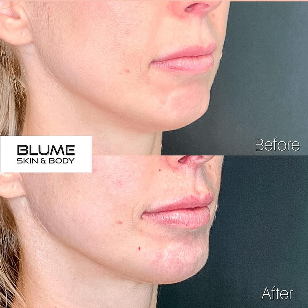 Dermal Fillers Before & After