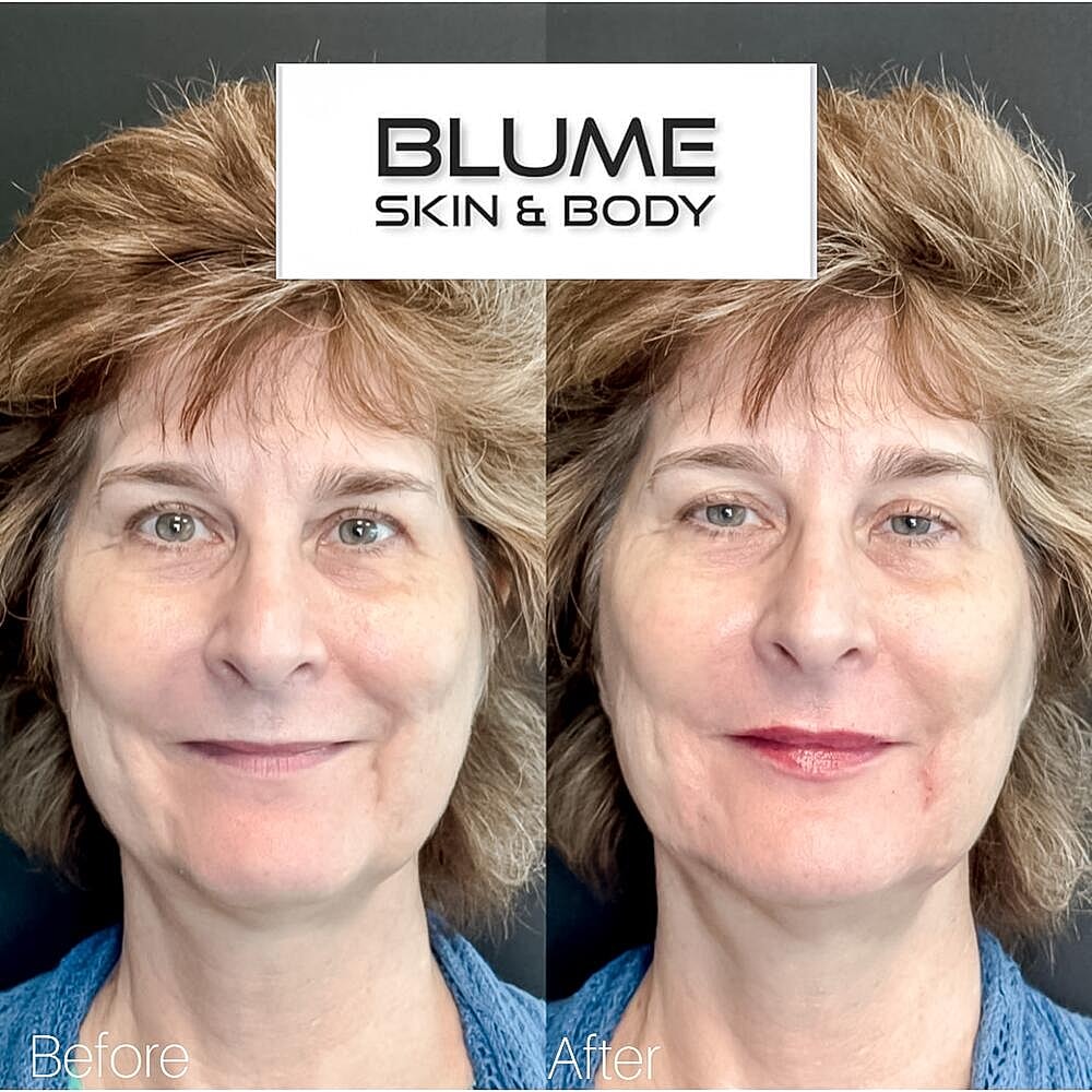 Dermal Fillers Before & After