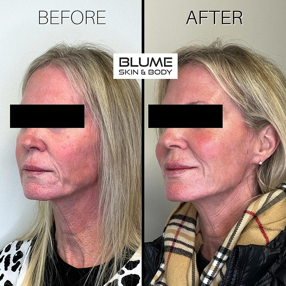 Dermal Fillers Before & After