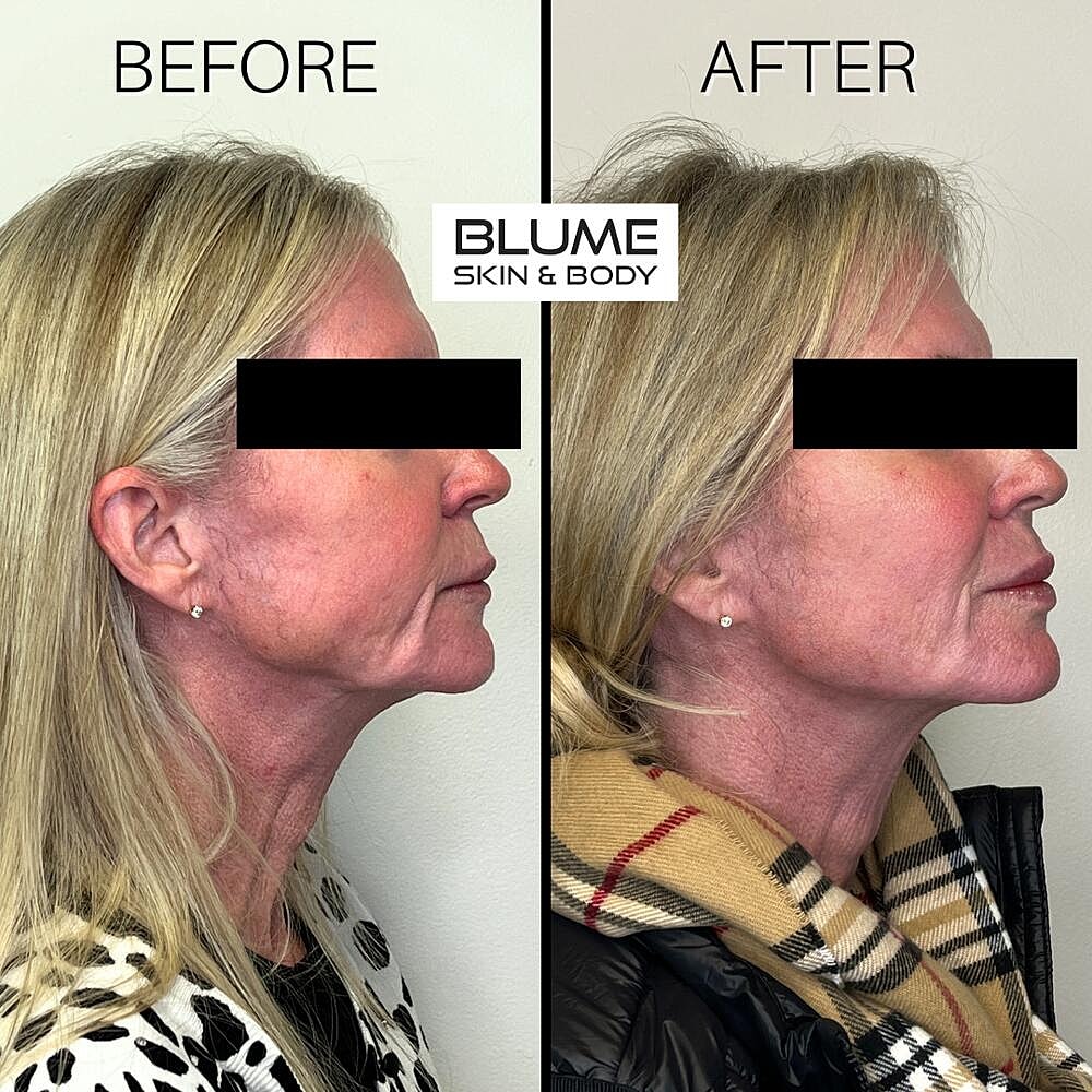 Dermal Fillers Before & After