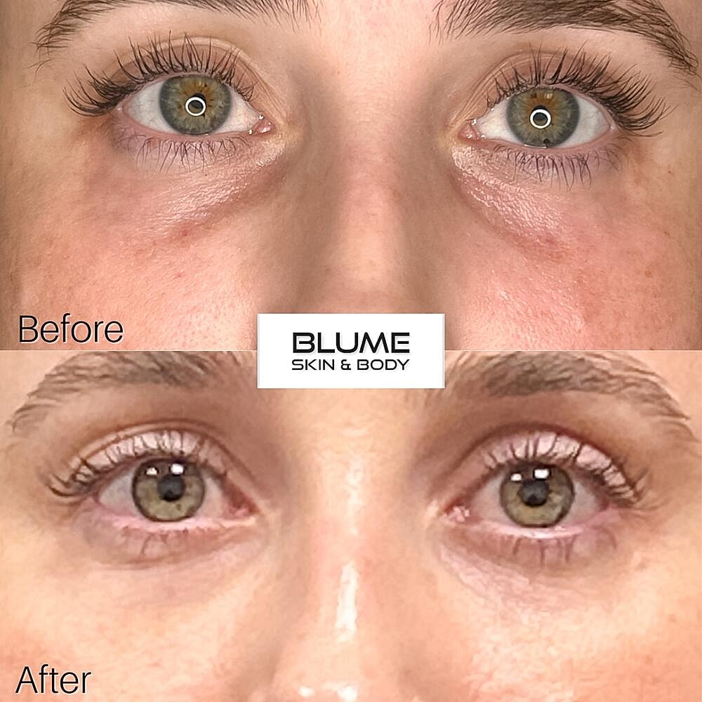 Dermal Fillers Before & After